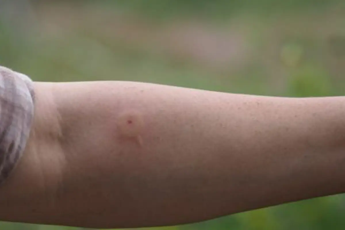 Les différentes douleurs suite à une piqûre d'insecte à Mérignac